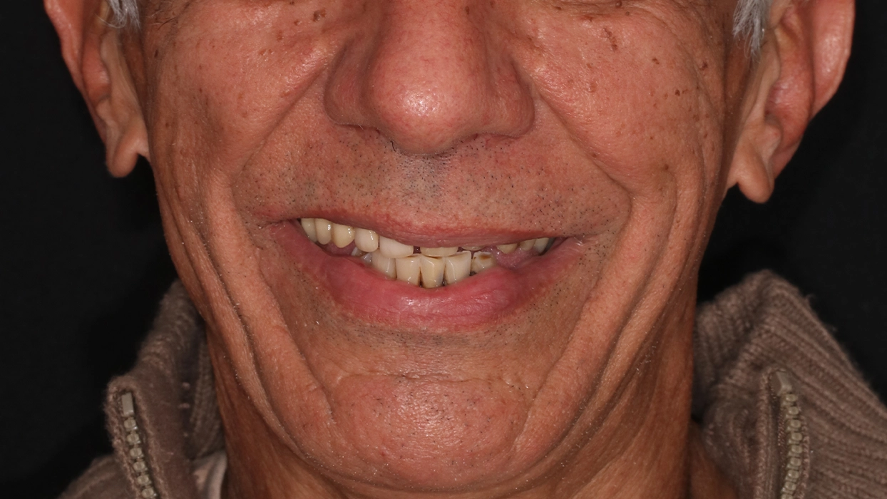 vanderley ANTES sorrindo